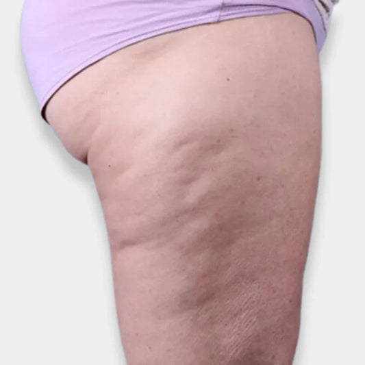 Come combattere efficacemente la cellulite?