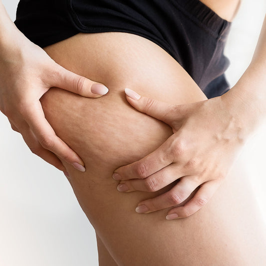 Come migliorare la circolazione per ridurre la cellulite